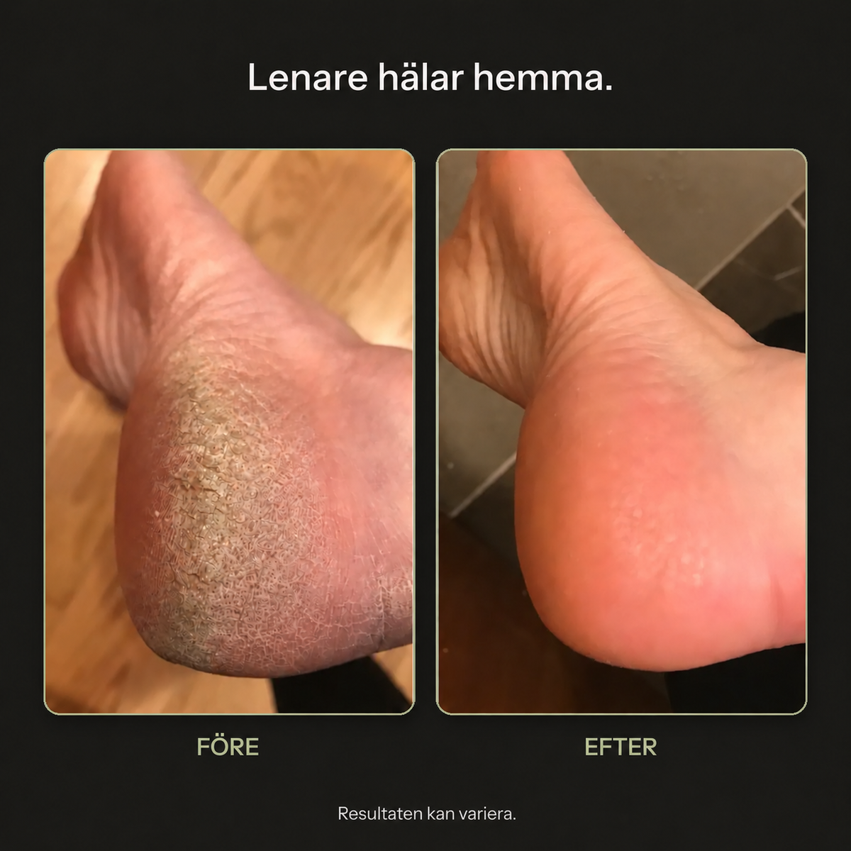 VIREVA — Före och efter fotvård