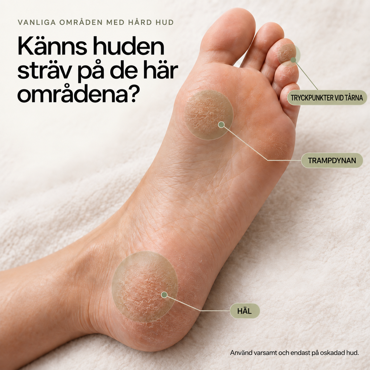 VIREVA — Vanliga områden med sträv hud